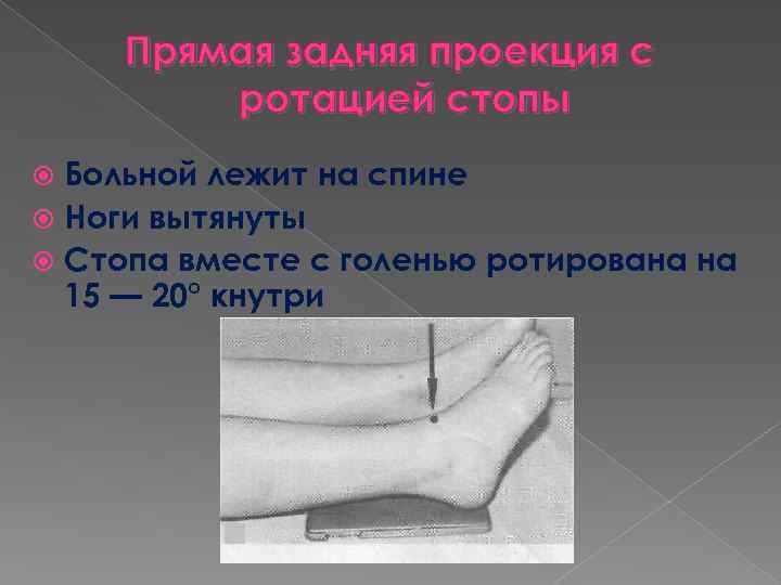 Прямая задняя проекция с ротацией стопы Больной лежит на спине Ноги вытянуты Стопа вместе