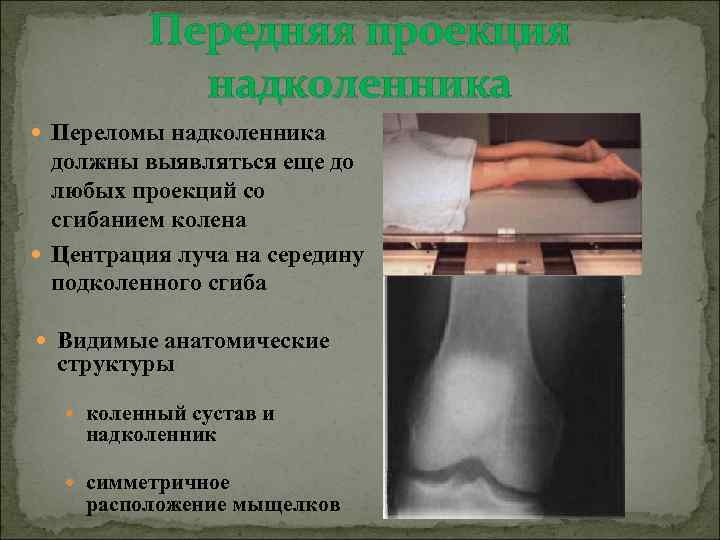 Передняя проекция надколенника Переломы надколенника должны выявляться еще до любых проекций со сгибанием колена