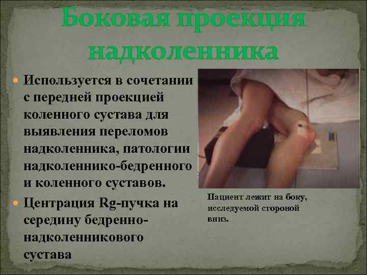 Боковая проекция надколенника Используется в сочетании с передней проекцией коленного сустава для выявления переломов