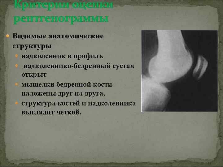 Критерии оценки рентгенограммы Видимые анатомические структуры надколенник в профиль надколеннико-бедренный сустав открыт мыщелки бедренной
