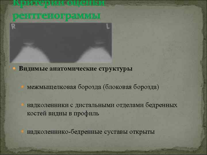 Критерии оценки рентгенограммы Видимые анатомические структуры межмыщелковая борозда (блоковая борозда) надколенники с дистальными отделами