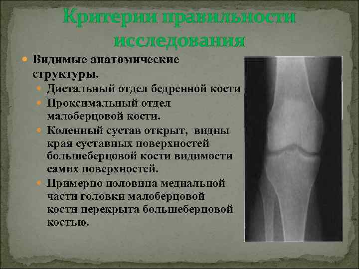 Критерии правильности исследования Видимые анатомические структуры. Дистальный отдел бедренной кости Проксимальный отдел малоберцовой кости.