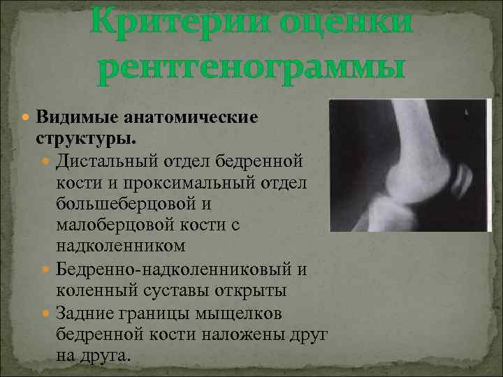 Критерии оценки рентгенограммы Видимые анатомические структуры. Дистальный отдел бедренной кости и проксимальный отдел большеберцовой