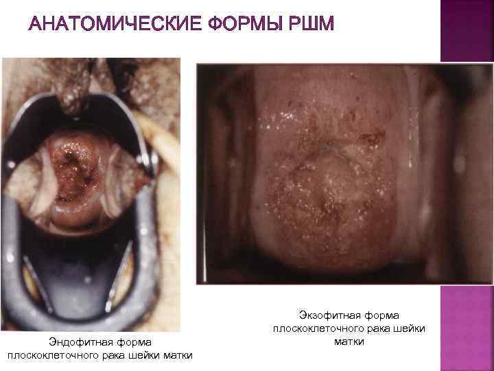 АНАТОМИЧЕСКИЕ ФОРМЫ РШМ Эндофитная форма плоскоклеточного рака шейки матки Экзофитная форма плоскоклеточного рака шейки