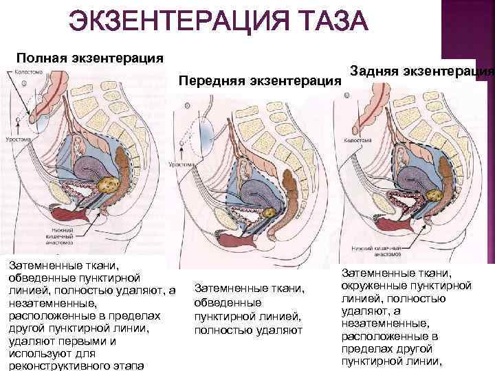ЭКЗЕНТЕРАЦИЯ ТАЗА Полная экзентерация Передняя экзентерация Затемненные ткани, обведенные пунктирной линией, полностью удаляют, а