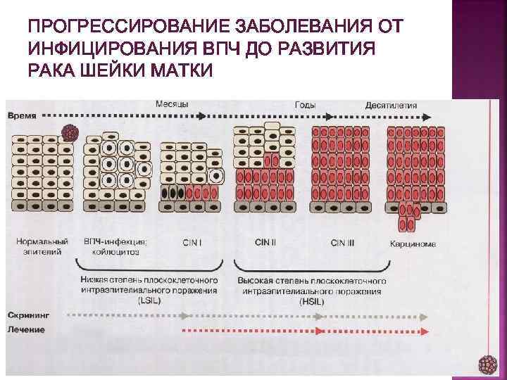 ПРОГРЕССИРОВАНИЕ ЗАБОЛЕВАНИЯ ОТ ИНФИЦИРОВАНИЯ ВПЧ ДО РАЗВИТИЯ РАКА ШЕЙКИ МАТКИ 
