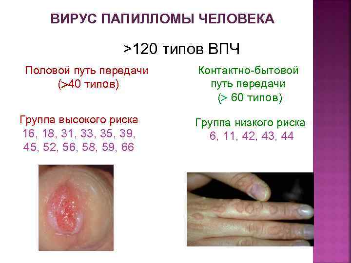 ВИРУС ПАПИЛЛОМЫ ЧЕЛОВЕКА >120 типов ВПЧ Половой путь передачи ( 40 типов) Группа высокого