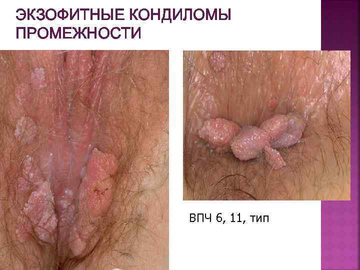 ЭКЗОФИТНЫЕ КОНДИЛОМЫ ПРОМЕЖНОСТИ ВПЧ 6, 11, тип 
