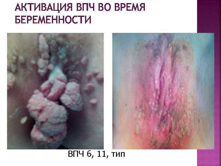 АКТИВАЦИЯ ВПЧ ВО ВРЕМЯ БЕРЕМЕННОСТИ ВПЧ 6, 11, тип 