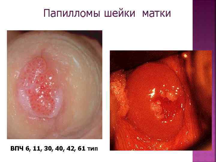 Папилломы шейки матки ВПЧ 6, 11, 30, 42, 61 тип 