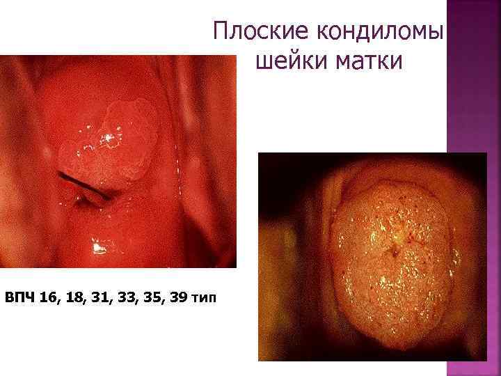 Плоские кондиломы шейки матки ВПЧ 16, 18, 31, 33, 35, 39 тип 
