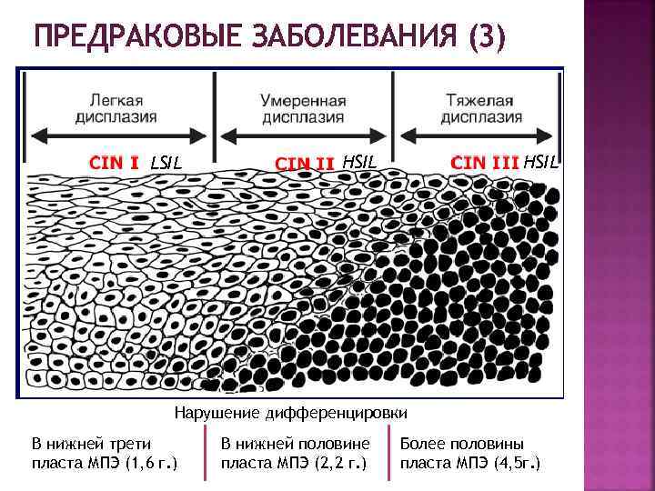 ПРЕДРАКОВЫЕ ЗАБОЛЕВАНИЯ (3) LSIL HSIL Нарушение дифференцировки В нижней трети пласта МПЭ (1, 6