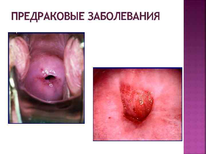 ПРЕДРАКОВЫЕ ЗАБОЛЕВАНИЯ 