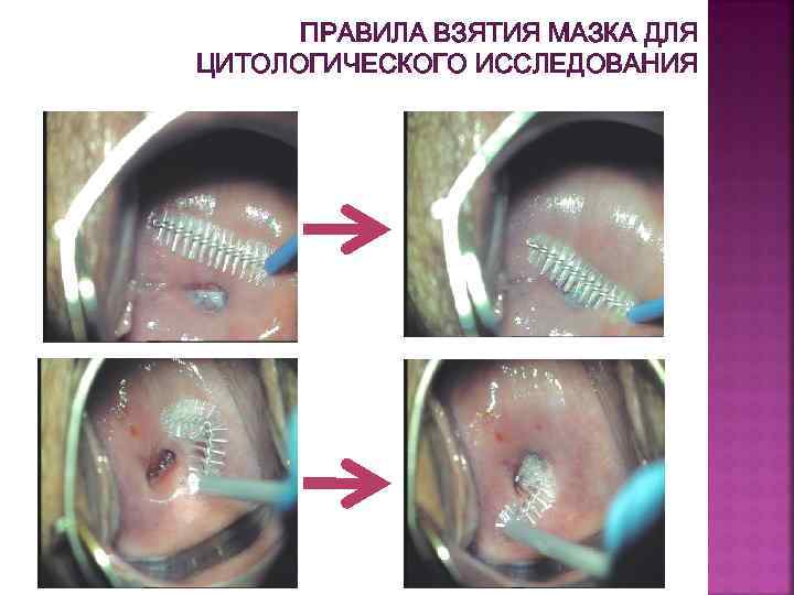ПРАВИЛА ВЗЯТИЯ МАЗКА ДЛЯ ЦИТОЛОГИЧЕСКОГО ИССЛЕДОВАНИЯ 