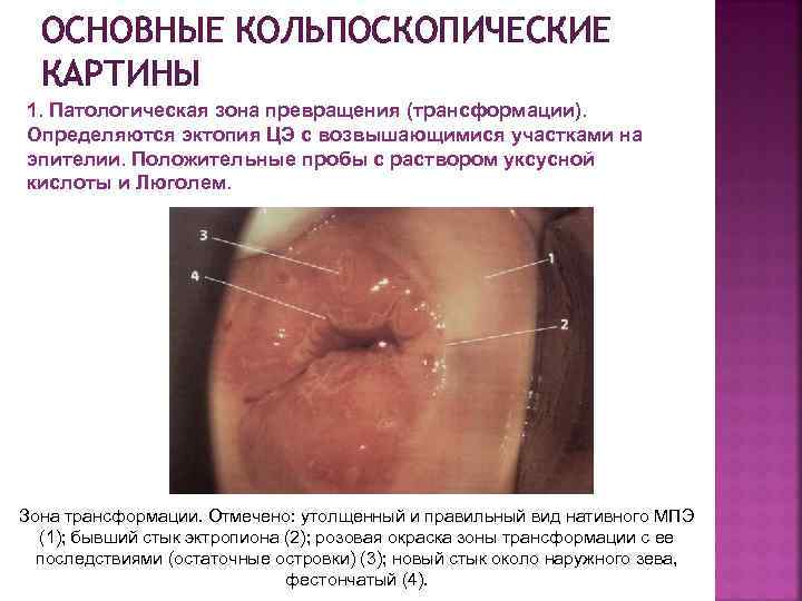 ОСНОВНЫЕ КОЛЬПОСКОПИЧЕСКИЕ КАРТИНЫ 1. Патологическая зона превращения (трансформации). Определяются эктопия ЦЭ с возвышающимися участками