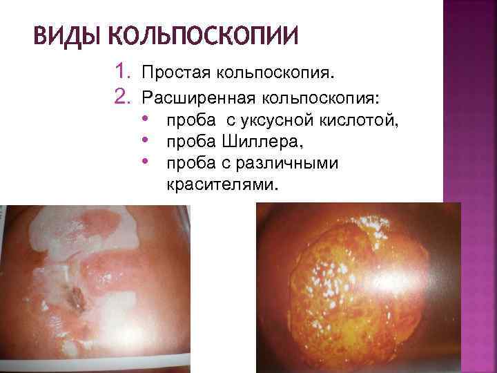 ВИДЫ КОЛЬПОСКОПИИ 1. Простая кольпоскопия. 2. Расширенная кольпоскопия: • проба с уксусной кислотой, •