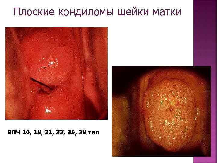 Плоские кондиломы шейки матки ВПЧ 16, 18, 31, 33, 35, 39 тип 