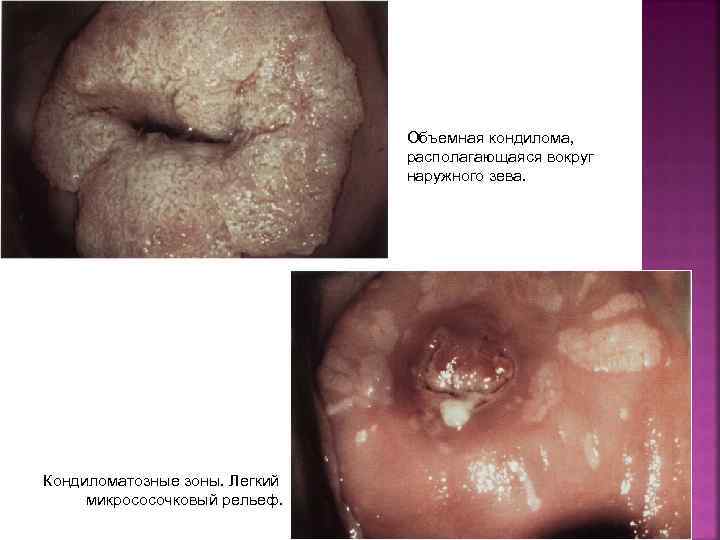 Объемная кондилома‚ располагающаяся вокруг наружного зева. Кондиломатозные зоны. Легкий микрососочковый рельеф. 