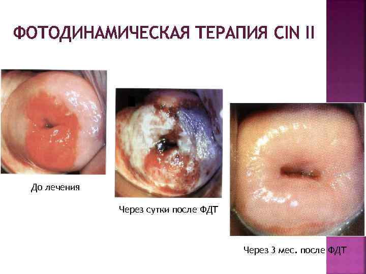 ФОТОДИНАМИЧЕСКАЯ ТЕРАПИЯ CIN II До лечения Через сутки после ФДТ Через 3 мес. после