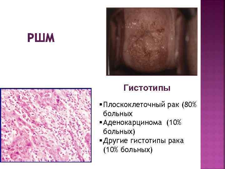 РШМ Гистотипы § Плоскоклеточный рак (80% больных § Аденокарцинома (10% больных) § Другие гистотипы