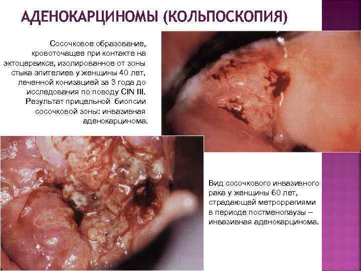 АДЕНОКАРЦИНОМЫ (КОЛЬПОСКОПИЯ) Сосочковое образование‚ кровоточащее при контакте на эктоцервиксе‚ изолированное от зоны стыка эпителиев