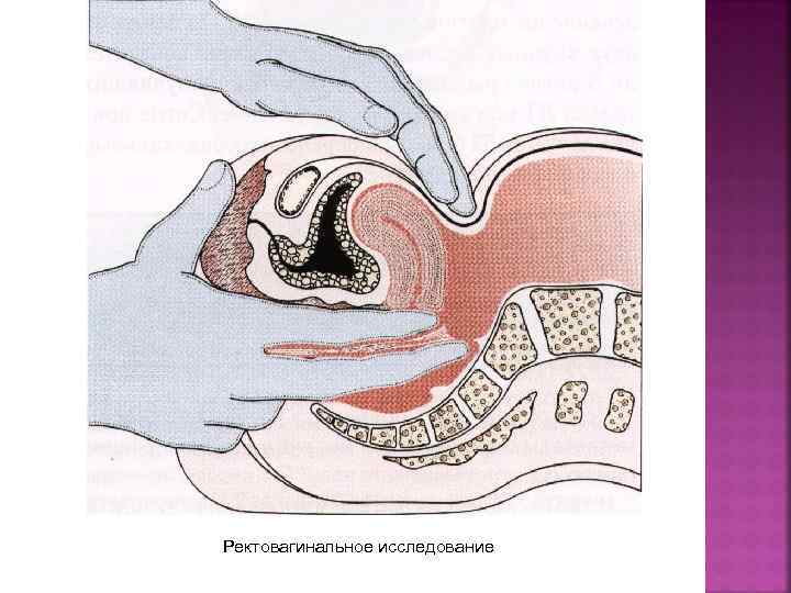 Ректовагинальное исследование 