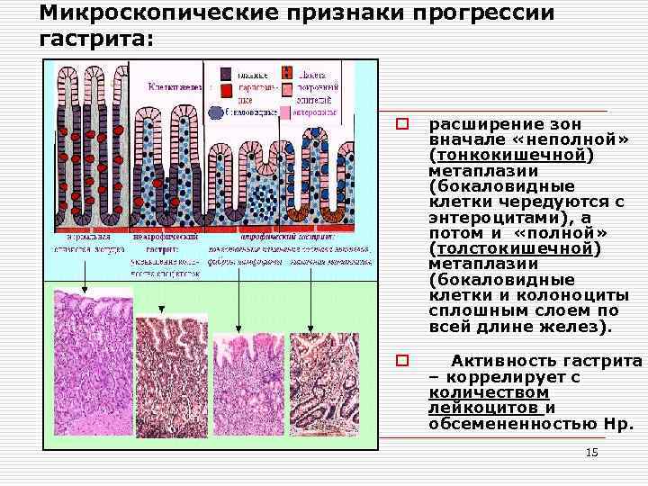 Микроскопические признаки прогрессии гастрита: o расширение зон вначале «неполной» (тонкокишечной) метаплазии (бокаловидные клетки чередуются