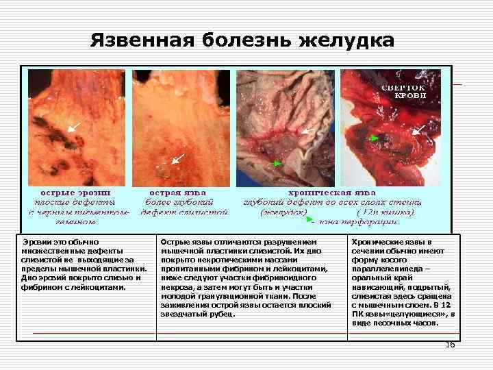 Язвенная болезнь желудка o Эрозии это обычно множественные дефекты слизистой не выходящие за пределы
