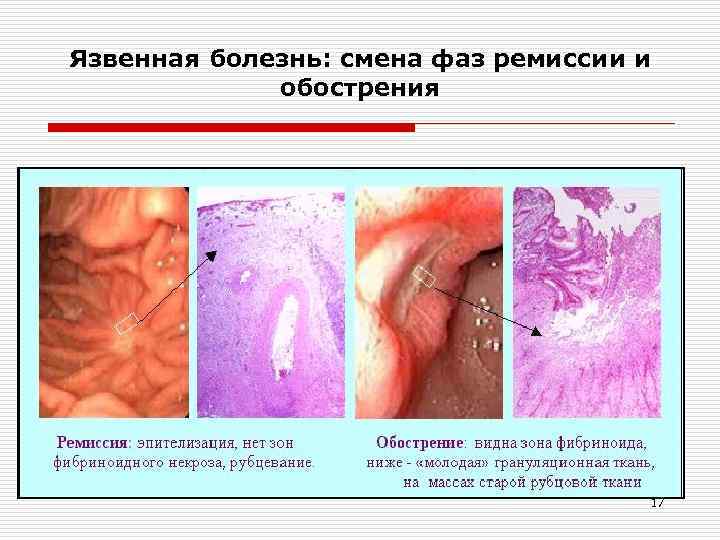 Язвенная болезнь: смена фаз ремиссии и обострения 17 