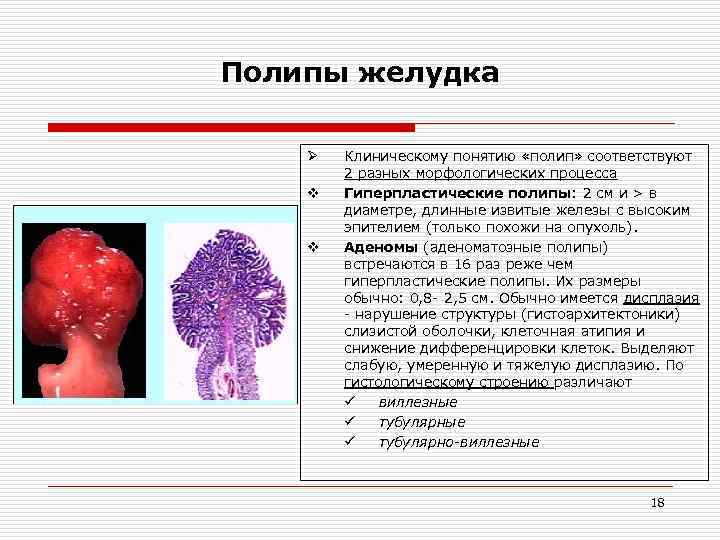 Полипы желудка Ø v v Клиническому понятию «полип» соответствуют 2 разных морфологических процесса Гиперпластические