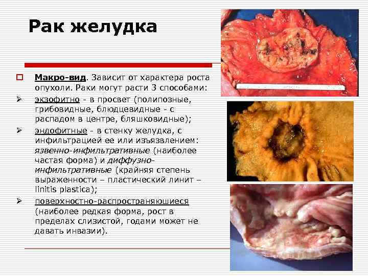 Рак желудка o Ø Ø Ø Макро-вид. Зависит от характера роста опухоли. Раки могут