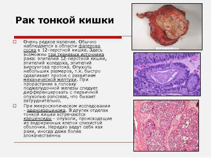 Рак тонкой кишки o o Очень редкое явление. Обычно наблюдается в области фатерова соска