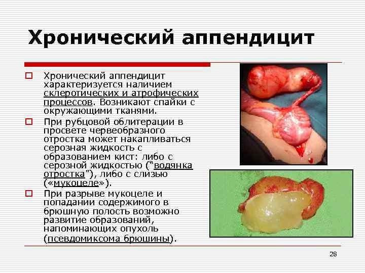 Хронический аппендицит o o o Хронический аппендицит характеризуется наличием склеротических и атрофических процессов. Возникают