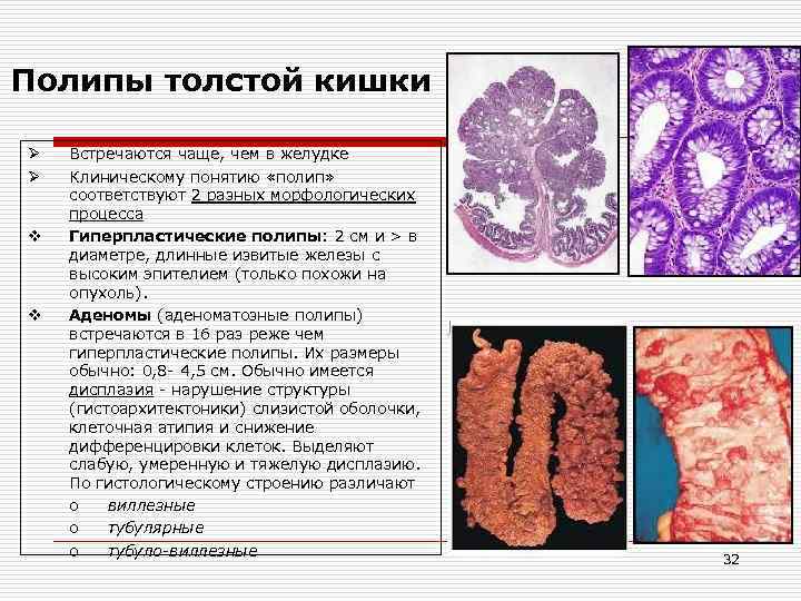 Полипы толстой кишки Ø Ø v v Встречаются чаще, чем в желудке Клиническому понятию