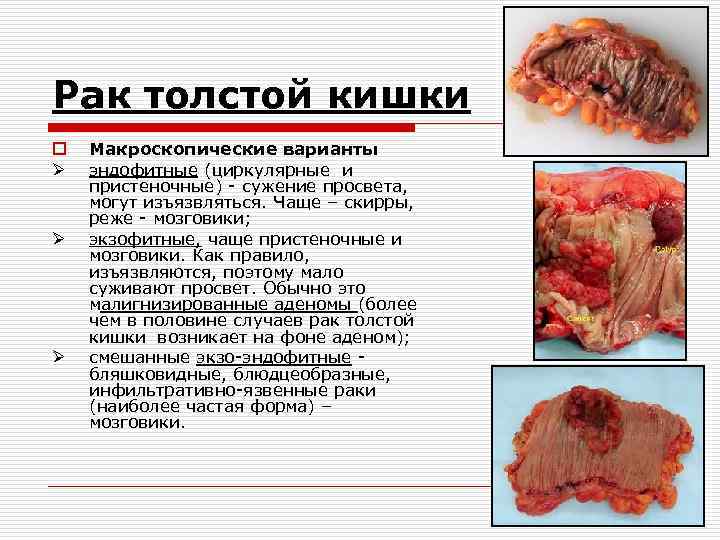 Рак толстой кишки o Ø Ø Ø Макроскопические варианты эндофитные (циркулярные и пристеночные) -