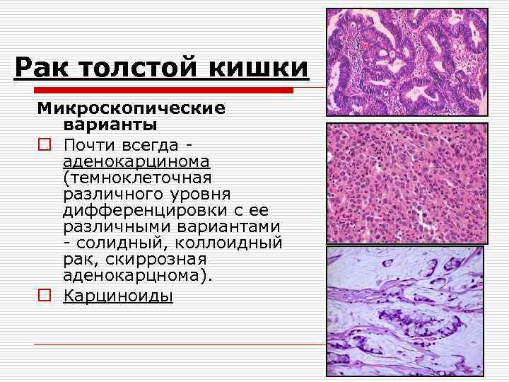 Рак толстой кишки Микроскопические варианты o Почти всегда - аденокарцинома (темноклеточная различного уровня дифференцировки