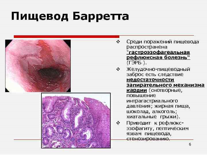 Пищевод Барретта v v v Среди поражений пищевода распространена "гастроэзофагеальная рефлюксная болезнь" (ГЭРБ ).