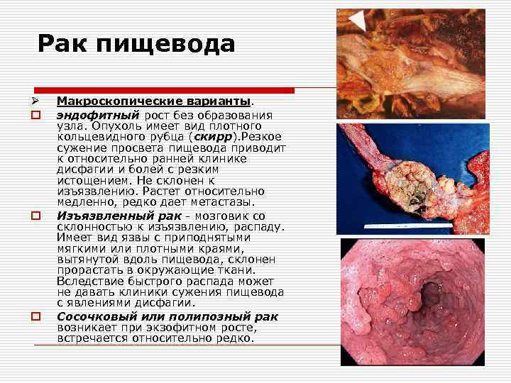 Рак пищевода Ø o o o Макроскопические варианты. эндофитный рост без образования узла. Опухоль