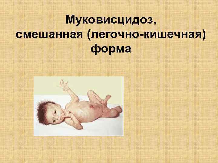 Муковисцидоз, смешанная (легочно-кишечная) форма 