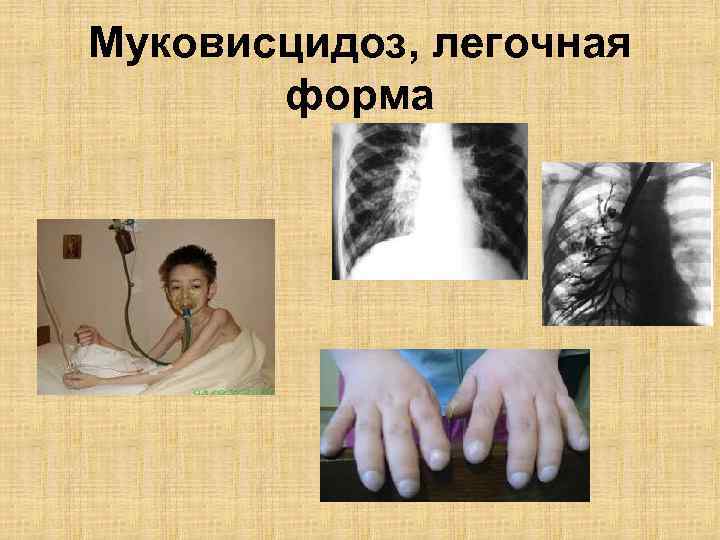 Муковисцидоз, легочная форма 