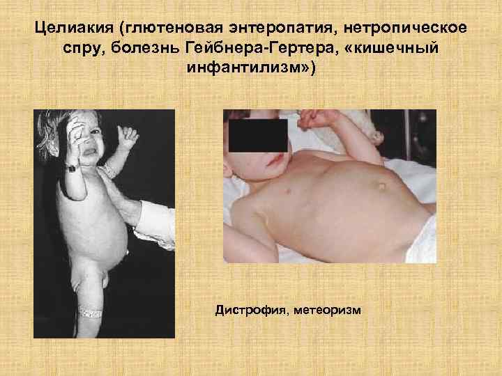 Целиакия (глютеновая энтеропатия, нетропическое спру, болезнь Гейбнера-Гертера, «кишечный инфантилизм» ) Дистрофия, метеоризм 