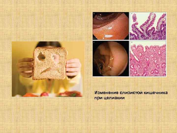 Изменение слизистой кишечника при целиакии 