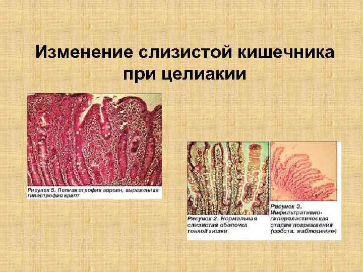 Изменение слизистой кишечника при целиакии 