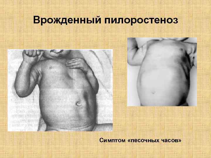 Врожденный пилоростеноз Симптом «песочных часов» 