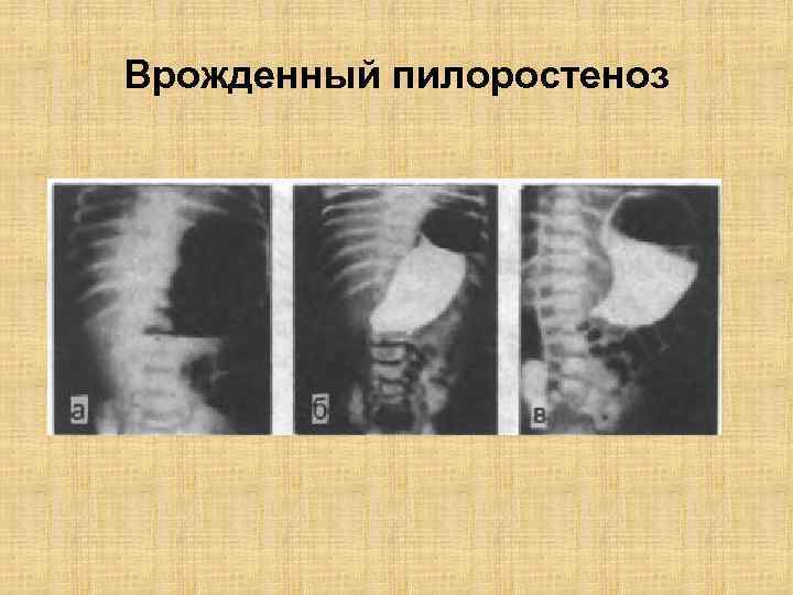 Пилоростеноз у детей презентация