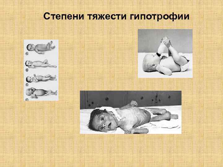 Степени тяжести гипотрофии 