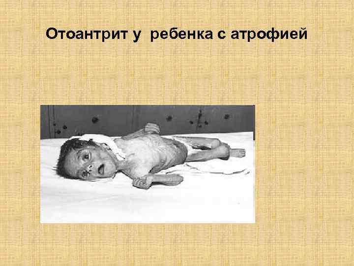 Отоантрит у ребенка с атрофией 