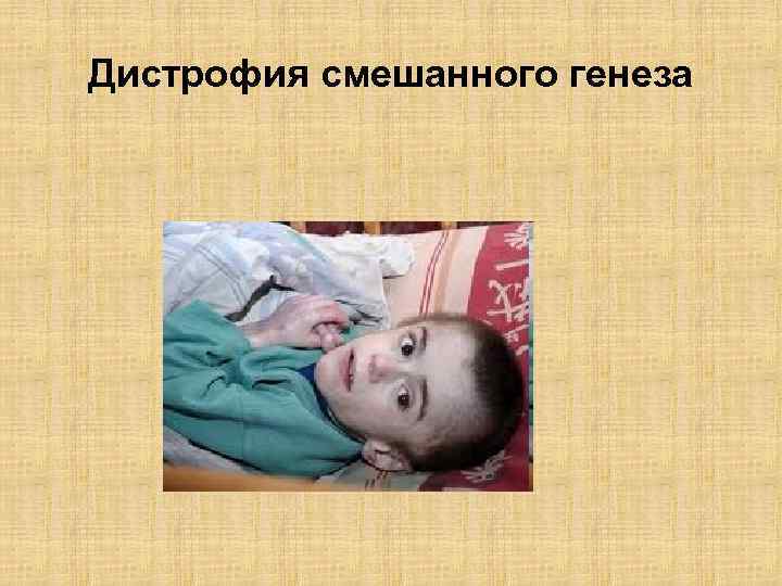 Дистрофия смешанного генеза 