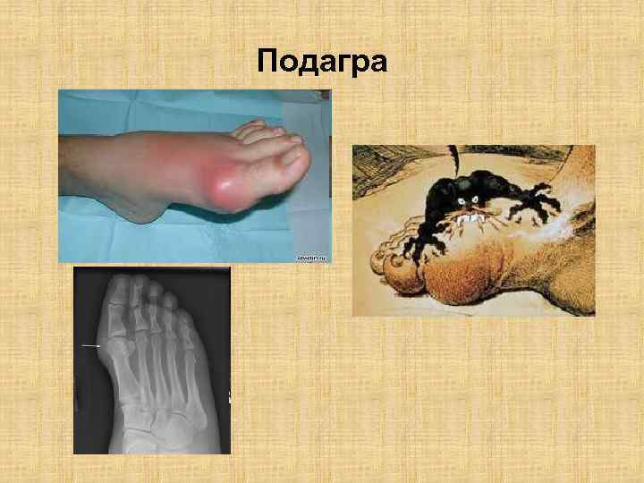 Подагра 