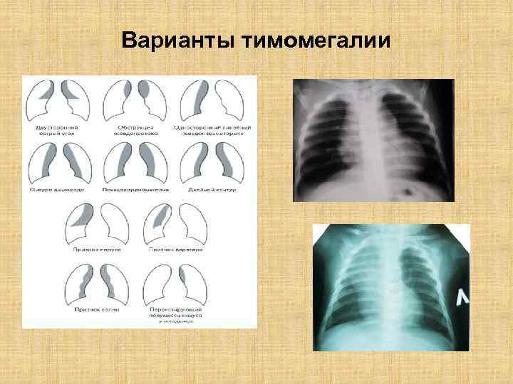 Варианты тимомегалии 
